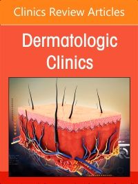 Psoriasis: Contemporary and Future Therapies, An Issue of Dermatologic Clinics, E-Book