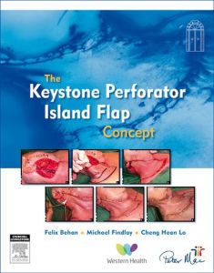 The Keystone Perforator Island Flap Concept - E-Book